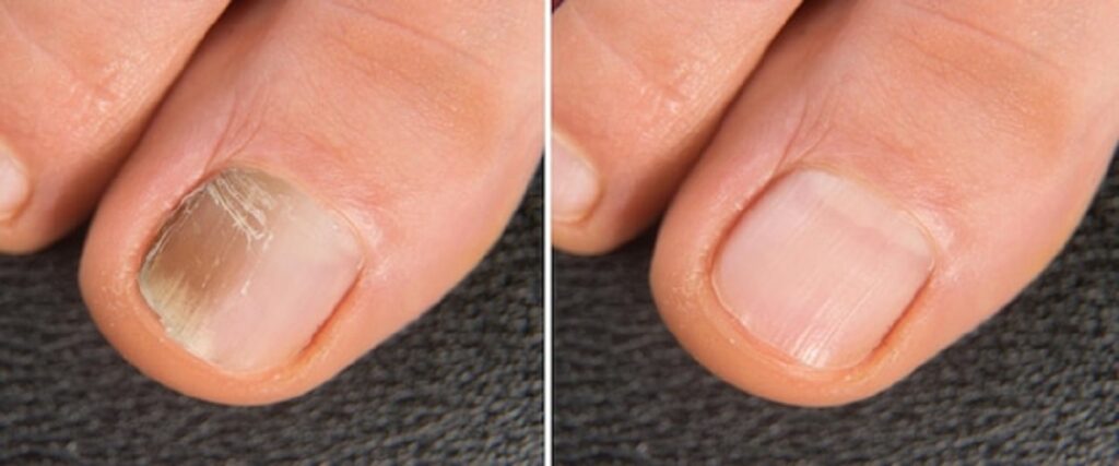 Un “antes y después” del tratamiento en Podólogos Asociados. Uñas libre de onicomicosis